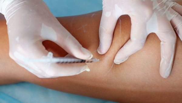 SKLEROTERAPIA – SPOSÓB NA ŻYLAKI